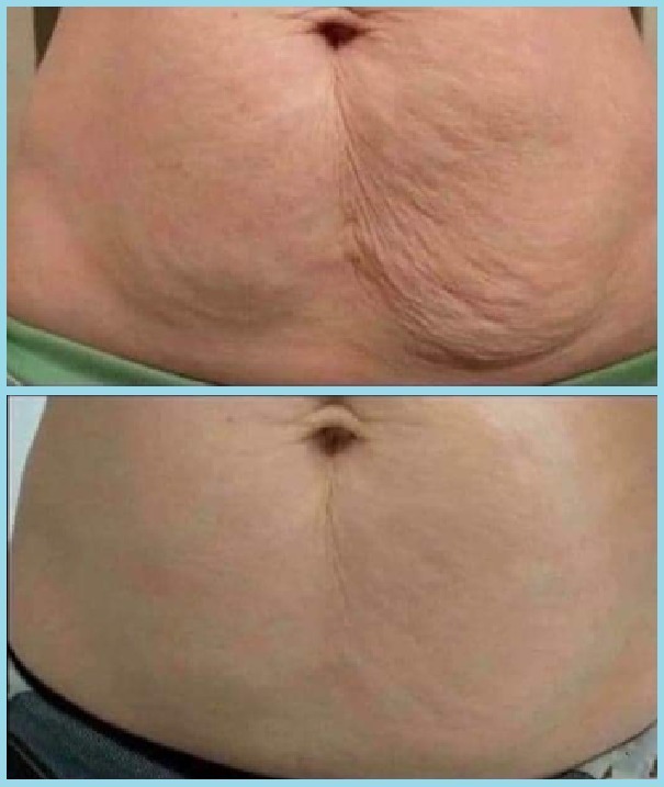 Aperta a pele flácida no abdómen, braços e pescoço naturalmente