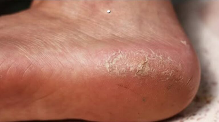 Como se livrar dos calos nos pés naturalmente